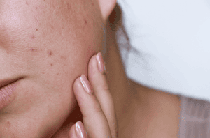 Acne Scarring 101: How to Treat Dark Spots and Acne Scars on Your Face